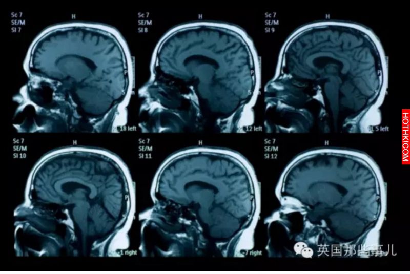 她的體內住了10多個不同的人格...其中竟然有一半是瞎子！心理醫生花了4年終於挖出她心 ...