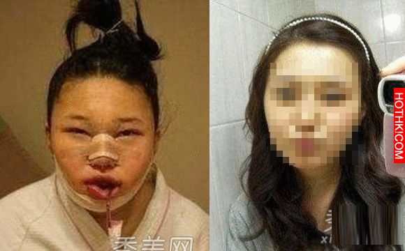 韓國女生整容過程真驚悚整完後美到不行