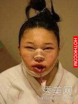 韓國女生整容過程真驚悚整完後美到不行