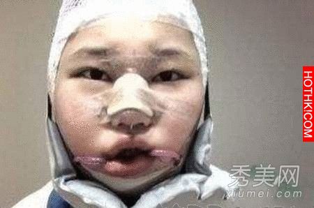 韓國女生整容過程真驚悚整完後美到不行