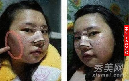 韓國女生整容過程真驚悚整完後美到不行