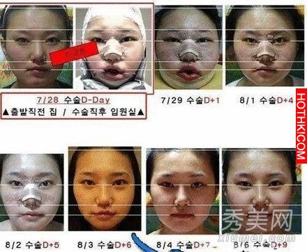 韓國女生整容過程真驚悚整完後美到不行
