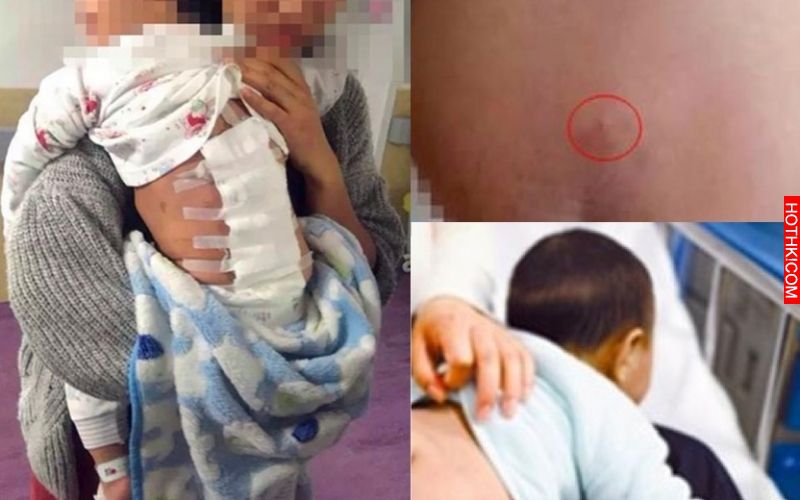 這個寶寶才16個月，愛跑愛跳的他卻突然站也站不住，只因為這一顆小小膿包導致癱瘓... ...