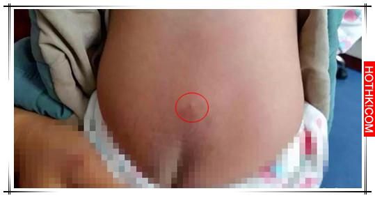 這個寶寶才16個月，愛跑愛跳的他卻突然站也站不住，只因為這一顆小小膿包導致癱瘓... ...