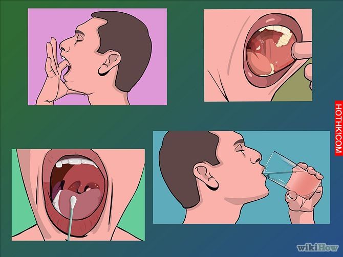 Image titled Remove Tonsil Stones (Tonsiliths) Step 8