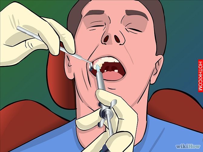 Image titled Remove Tonsil Stones (Tonsiliths) Step 18
