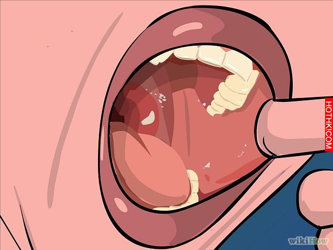 Image titled Remove Tonsil Stones (Tonsiliths) Step 3