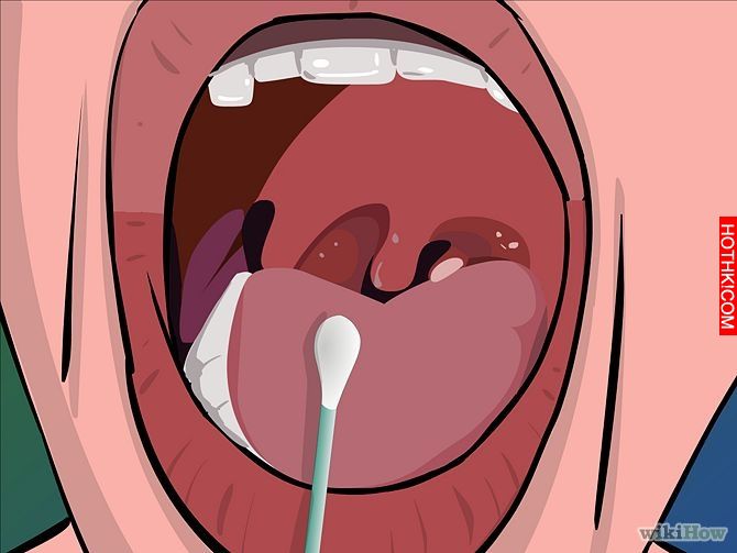 Image titled Remove Tonsil Stones (Tonsiliths) Step 4