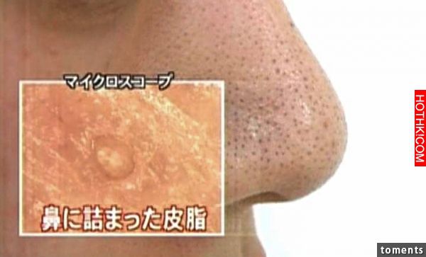 這些方法竟然可以完全讓毛孔痘疤消失無蹤，試完之後的成果．．．連我都不敢相信啦！ ...
