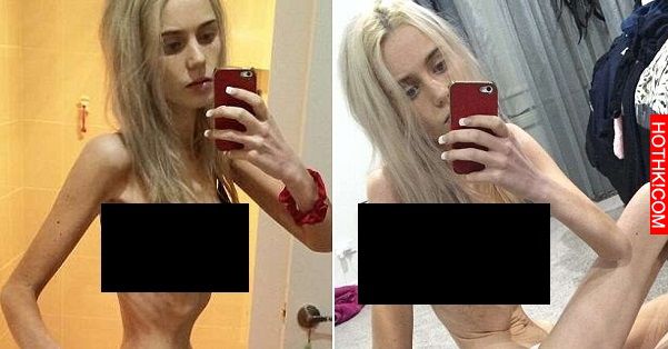 這女孩一個禮拜不吃不喝，不只骨頭跑出來見人...就連胸部都變成這種可怕的樣子！ ...