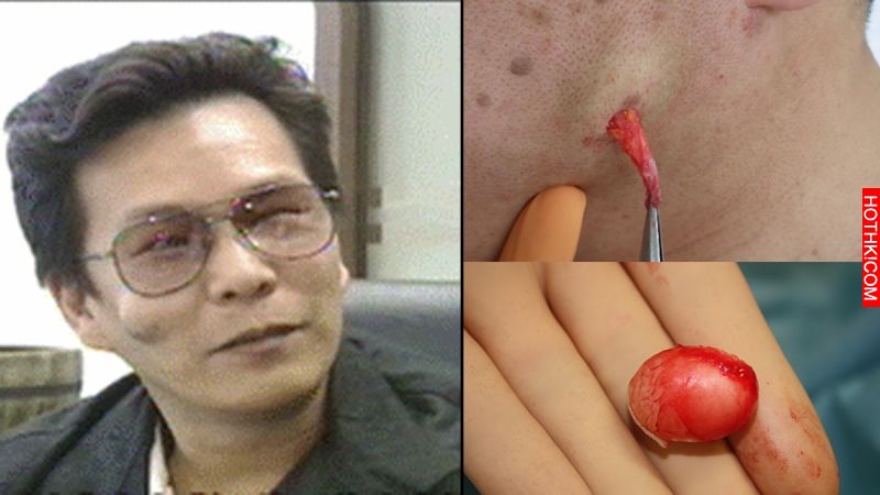 沈玉琳右臉頰「一大顆..」長年住在他皮膚裡，一待就是八年！除掉後，他的命運突然180 ...