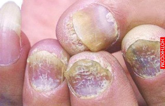 解決灰指甲的秘方，只要七天就能見效！！不要再塗奇奇怪怪的藥膏了！！！ ...