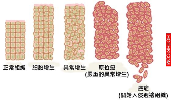 日本終於發現癌細胞的秘密了！原來癌細胞最怕的就是這個....這篇告訴您消除癌細胞最簡 ...