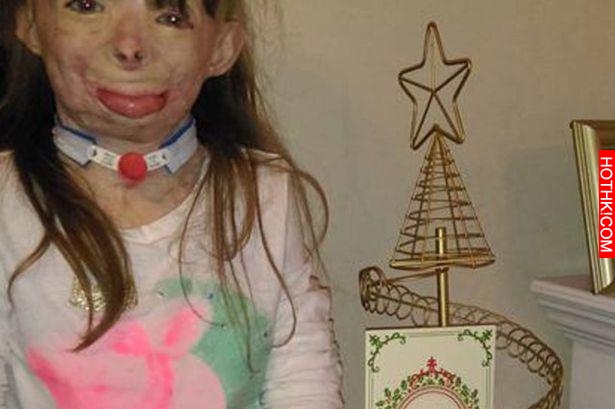 因大火變醜女孩失去右手和左腳 聖誕節網上許願
