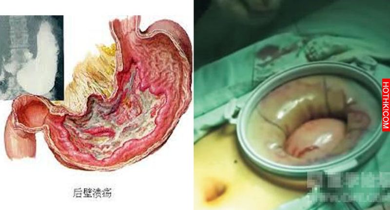 太恐怖了！年輕人得「胃癌」，全都因為這10個生活習慣，一定得留意！ ...