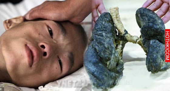 超恐怖 ! 這個男孩才20歲，肺竟全爛掉！只因為他常待在... 天啊! 超多人愛去!! ...