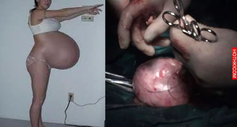 恐怖！17歲女停經5個月了，肚子越變越大！醫生從他肚子裡取出的不是嬰兒，而是一個恐 ...