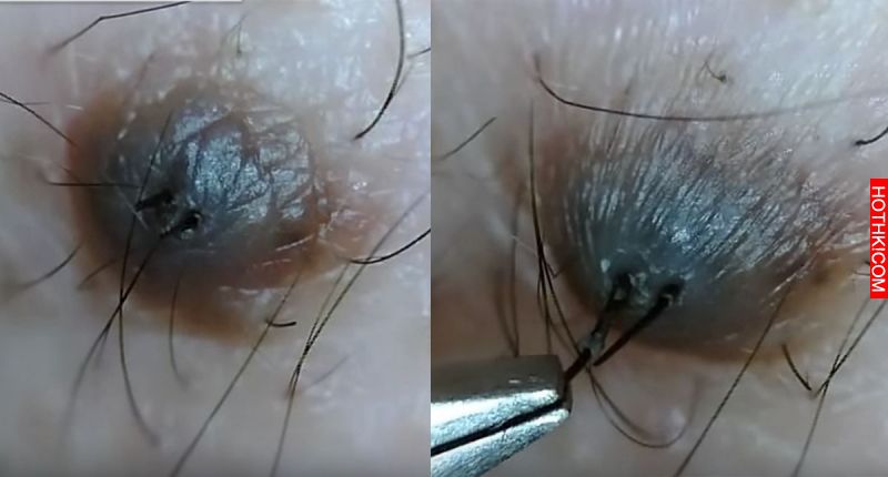 黑痣上有毛到底拔不拔？日本一網友在用鎳夾猛扯黑痣上的毛，看到最後感覺全身都痛麻了 ...