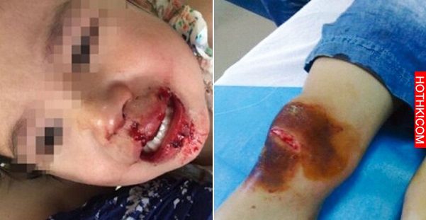 3歲女童被裹著大衣送醫，打開衣服後醫生震驚...她的外陰撕裂血流不止，身上的傷可見骨 ...