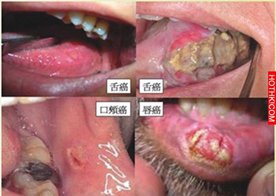 12月才最新公布的，每天吃一顆這個，可使口腔、食道和胃癌發生率減少一半，中風的發生 ...