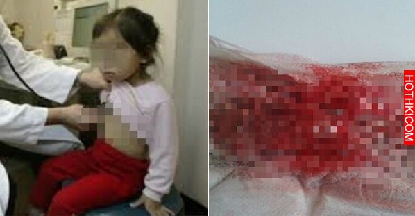女童下體不斷出血，醫生檢查後發現驚人事實...母親當場哭暈 ...