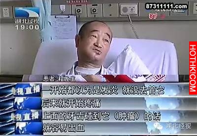 小心！他蛀牙未修補，竟得上了這個絕症！牙疼千萬不能掉以輕心！一定要分享出去！！ ...