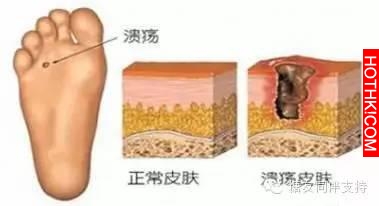 糖尿病友腳變成「焦炭」 ？怎麼防糖足，看這裡！