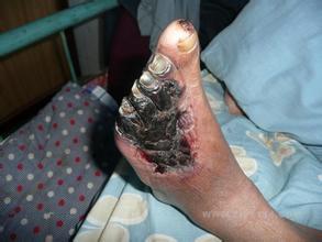 糖尿病友腳變成「焦炭」 ？怎麼防糖足，看這裡！