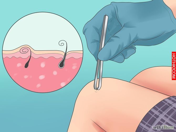Remove an Ingrown Hair Step 5 Version 3.jpg