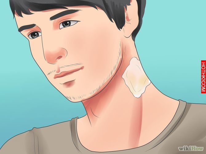 Remove an Ingrown Hair Step 14 Version 2.jpg