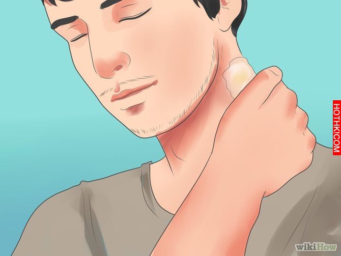 Remove an Ingrown Hair Step 13 Version 2.jpg