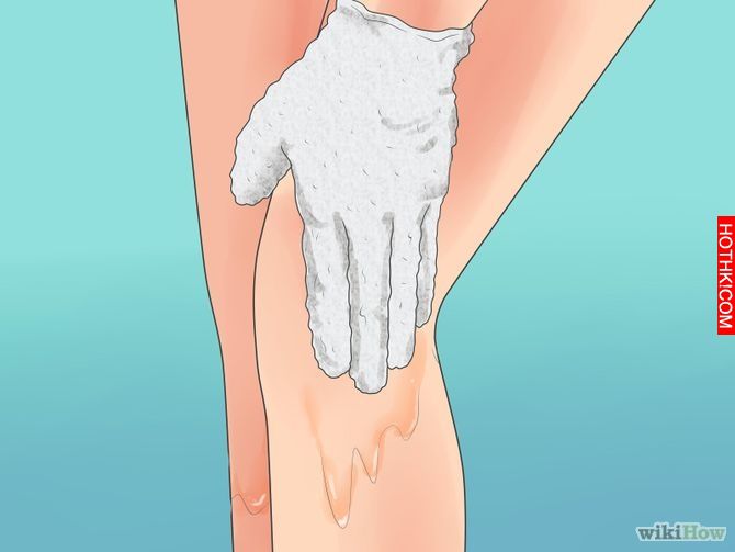 Remove an Ingrown Hair Step 2 Version 3.jpg