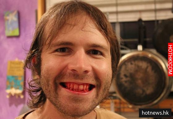 This Man Has Eaten Nothing But Raw Meat For Past Seven Years Article header image