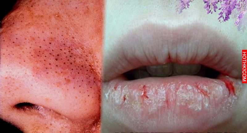 重要!臉不乾淨就是內臟有病!鼻頭粉刺、嘴裂、眼睛血絲代表了… ... 重要!臉不乾淨就是內臟有病!鼻頭粉刺、嘴裂、眼睛血絲代表了… ...