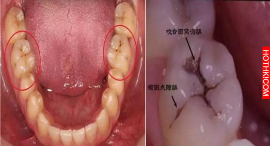 沒想到牙齒上的小黑點，竟然暗示著這麼可怕的訊息！不要再忽視了！轉發積功德！ ...
