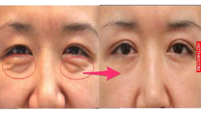好神奇！三分鐘後眼袋 魚尾紋全消失了！居然只要在水裡加入「這個東西」... ...