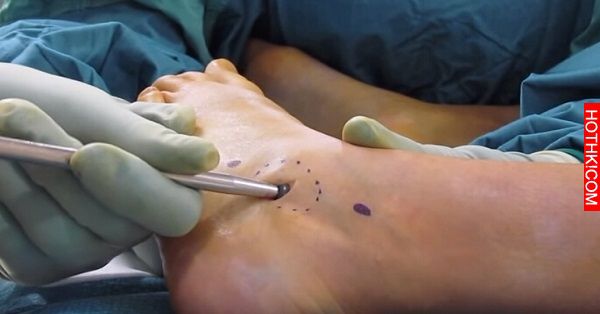 這男人腳劇痛後求醫...醫生從他腳踝挖出的東西太恐怖了...在場的護士不斷尖叫 ...