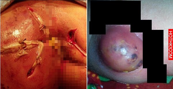 半歲童肛門周圍開了好幾個血洞...還長了大肉瘤，醫生一看之下發現每天晚上穿的「那種 ...