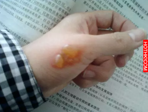 燙傷後趕快用它，連紅痕和水泡都不會有，比沖水更有效！！ ...
