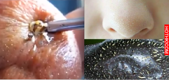 用好多「去黑頭」的方法卻絲毫沒有動搖，那是因為你的方法全錯了！快學「這招」一步到 ...