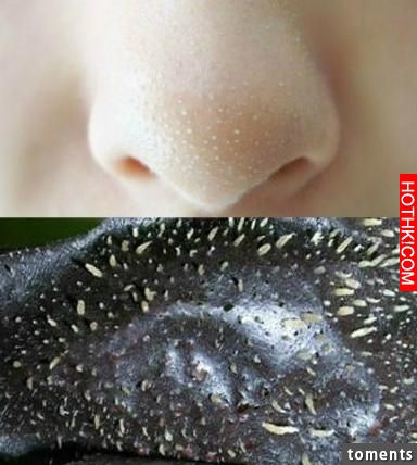 4大招讓黑頭永遠消失！毛孔變小了！粉刺痘痘通通不見了！太棒了一定要學起來！