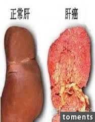 他的「右肩時常酸痛」結果竟是「肝癌」引起，發現時已經末期無法救回！有這5種症狀趕 ...