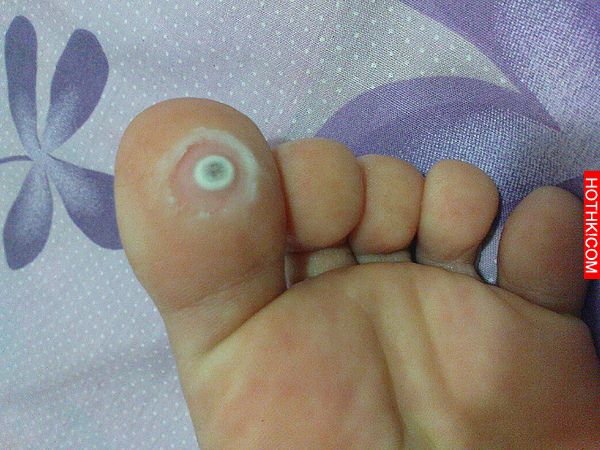 長「雞眼」該如何治療?千萬不要自行刮除,後果很嚴重啊...你一定要這樣做才對! ... 長「雞眼」該如何治療?千萬不要自行刮除,後果很嚴重啊...你一定要這樣做才對! ...