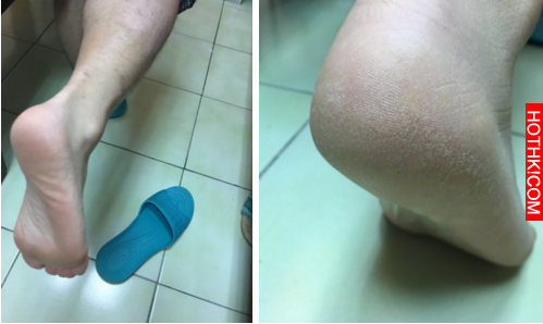 腳上老皮、老繭不用慌，教你使用小妙方，三天就讓你的腳粉嫩得像嬰兒一樣！ ...