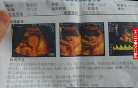 懷孕3個月產檢被告知四胞胎，然而再次產檢結果讓她瞬間變了臉色