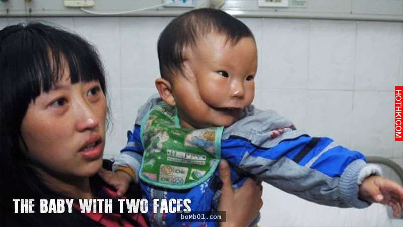 這孩子生下來就有「2張臉」，醫生掀開上面的臉發現底下竟然是... ...