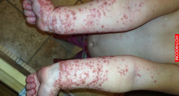 超恐怖!10歲孩子回家「突發紅疹」差點丟了性命,原因竟是...99%的家長會帶孩子去玩! ... 超恐怖!10歲孩子回家「突發紅疹」差點丟了性命,原因竟是...99%的家長會帶孩子去玩! ...