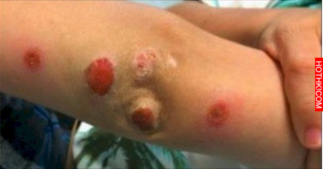 超恐怖！10歲孩子回家「突發紅疹」差點丟了性命，原因竟是...99%的家長會帶孩子去玩！ ...