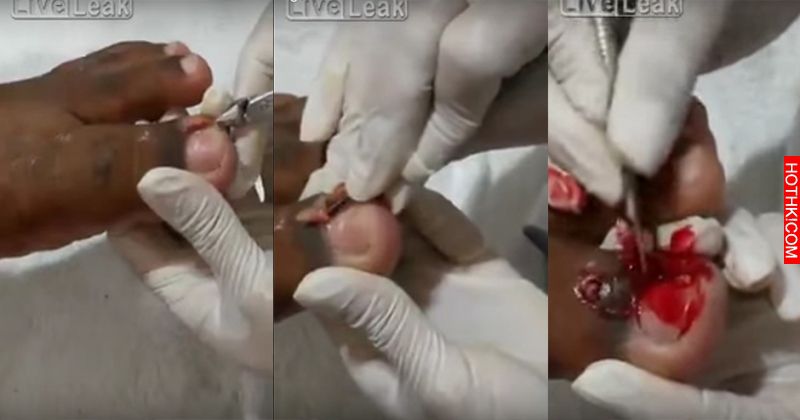 這個男的腳趾甲內生一直很痛！當手術刀從他腳趾挖出指甲後竟然還噴出兩隻「不明生物」 ... ...
