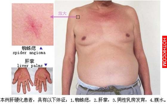 原來肝病跟肝硬化居然是有救的！！只要每天靠＂這個＂，效果真的太神奇了！平常多吃也 ...